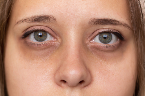 Une femme qui a des cernes sous les yeux