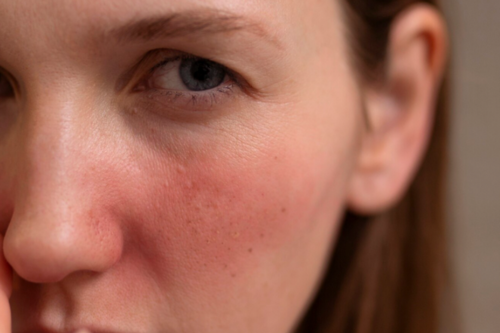 une femme avec des rougeurs sur le visage