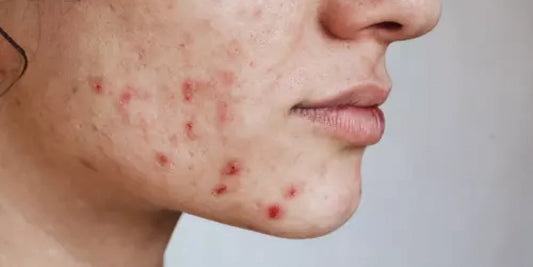eviter-effet-rebond-acne-apres-ete
