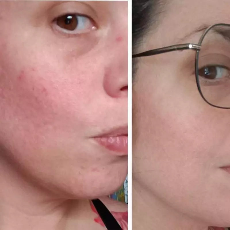 ROUTINE ANTI-IMPERFECTIONS – Peau sèche à sensible