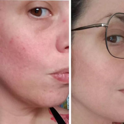 ROUTINE ANTI-IMPERFECTIONS – Peau sèche à sensible