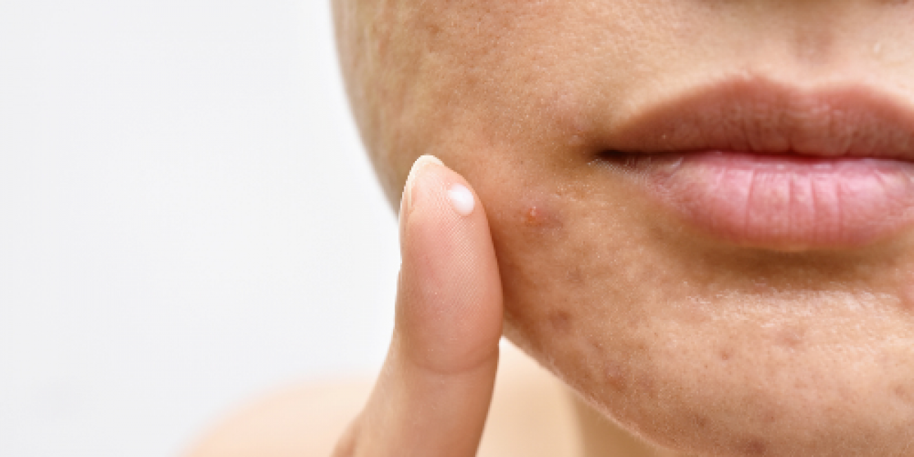 Peau acnéique : comment en prendre soin ?