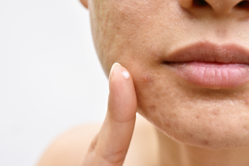Peau acnéique : comment en prendre soin ?