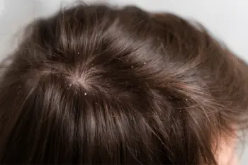 gros plan sur des cheveux avec des pellicules