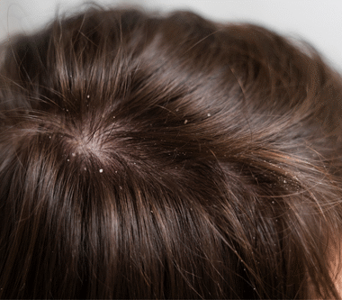 Quelles solutions naturelles pour un cuir chevelu sain sans pellicules ?