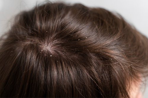 gros plan sur des cheveux avec des pellicules