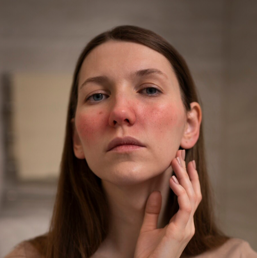 une femme avec des rougeurs sur les joues