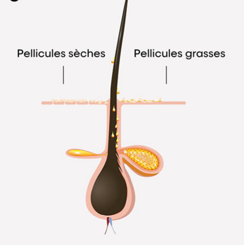 schema de pellicules grasses vs pellicules sèches
