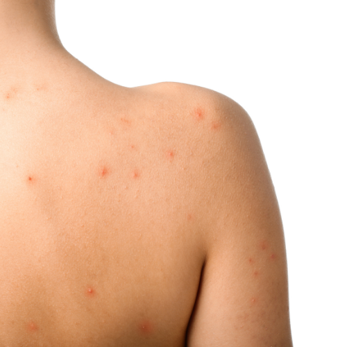 boutons de chaleur sur le dos et les épaules d'une femme